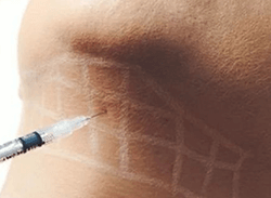 Fat dissolving Injections